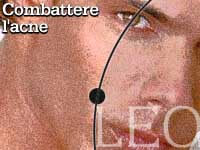 COMBATTERE L’ACNE