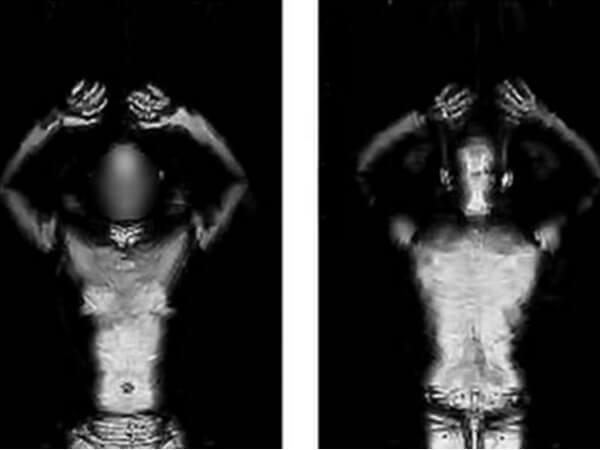 Transgender ha dovuto rimuovere protesi pene per passare il body scan