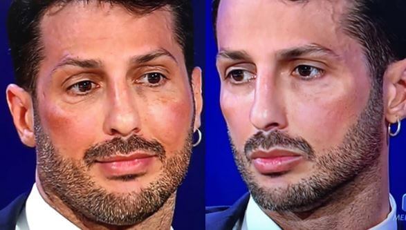 fabrizio_corona_zigomi