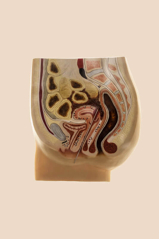 In the picture a three-dimensional longitudinal cross-sections of the body show clearly the great danger of illegal abortions performed by non-professionals using objects not intended for the purpose. When abortions are illegal, certain medical instruments can be a giveaway. For this reason, specific tools have never been developed or sold for this procedure. Instead, doctors, back-street abortionists and pregnant women themselves used whatever was available, items that were more or less suitable for their purposes: knitting needles, wire clothes hangers, urinary catheters and a wide variety of other objects, providing they were long enough to reach into the uterus. In places where abortions were illegal, pregnant women tend to ignore their condition for as long as possible, thereby wasting valuable time until they find help. For this reason, abortions are often performed at an extremely late date, at some point in the second trimester on the average. Whatever instrument is being used is then inserted through the cervix to open the amniotic sac. This induces labour, resulting in expulsion of the embryo. In the history of coercive reproduction, before the legalization of abortion ? and currently in the countries which remains illegal; was dominated for centuries by restrictive laws, based on demographic and religious agendas. Due the lack of alternatives, women was forced to apply dangerous methods for termination of her pregnancy, facing serious physical damage or even death. Both safe and very effective methods were only developed as of the middle of the last century.  The lives and the survival rate of women have thereby greatly improved. Museum of contraception and Abortion, Vienna, Austria, August 2015. Laia Abril / INSTITUTE