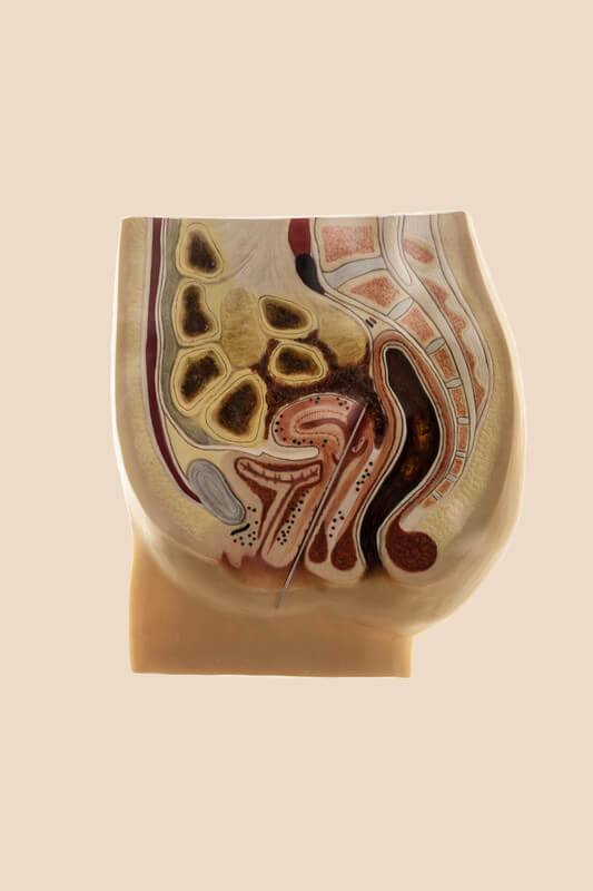 In the picture a three-dimensional longitudinal cross-sections of the body show clearly the great danger of illegal abortions performed by non-professionals using objects not intended for the purpose. When abortions are illegal, certain medical instruments can be a giveaway. For this reason, specific tools have never been developed or sold for this procedure. Instead, doctors, back-street abortionists and pregnant women themselves used whatever was available, items that were more or less suitable for their purposes: knitting needles, wire clothes hangers, urinary catheters and a wide variety of other objects, providing they were long enough to reach into the uterus. In places where abortions were illegal, pregnant women tend to ignore their condition for as long as possible, thereby wasting valuable time until they find help. For this reason, abortions are often performed at an extremely late date, at some point in the second trimester on the average. Whatever instrument is being used is then inserted through the cervix to open the amniotic sac. This induces labour, resulting in expulsion of the embryo. In the history of coercive reproduction, before the legalization of abortion ? and currently in the countries which remains illegal; was dominated for centuries by restrictive laws, based on demographic and religious agendas. Due the lack of alternatives, women was forced to apply dangerous methods for termination of her pregnancy, facing serious physical damage or even death. Both safe and very effective methods were only developed as of the middle of the last century. The lives and the survival rate of women have thereby greatly improved. Museum of contraception and Abortion, Vienna, Austria, August 2015. Laia Abril / INSTITUTE