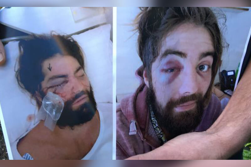 Aggressione omofoba: preso a pugni, rimane cieco da un occhio