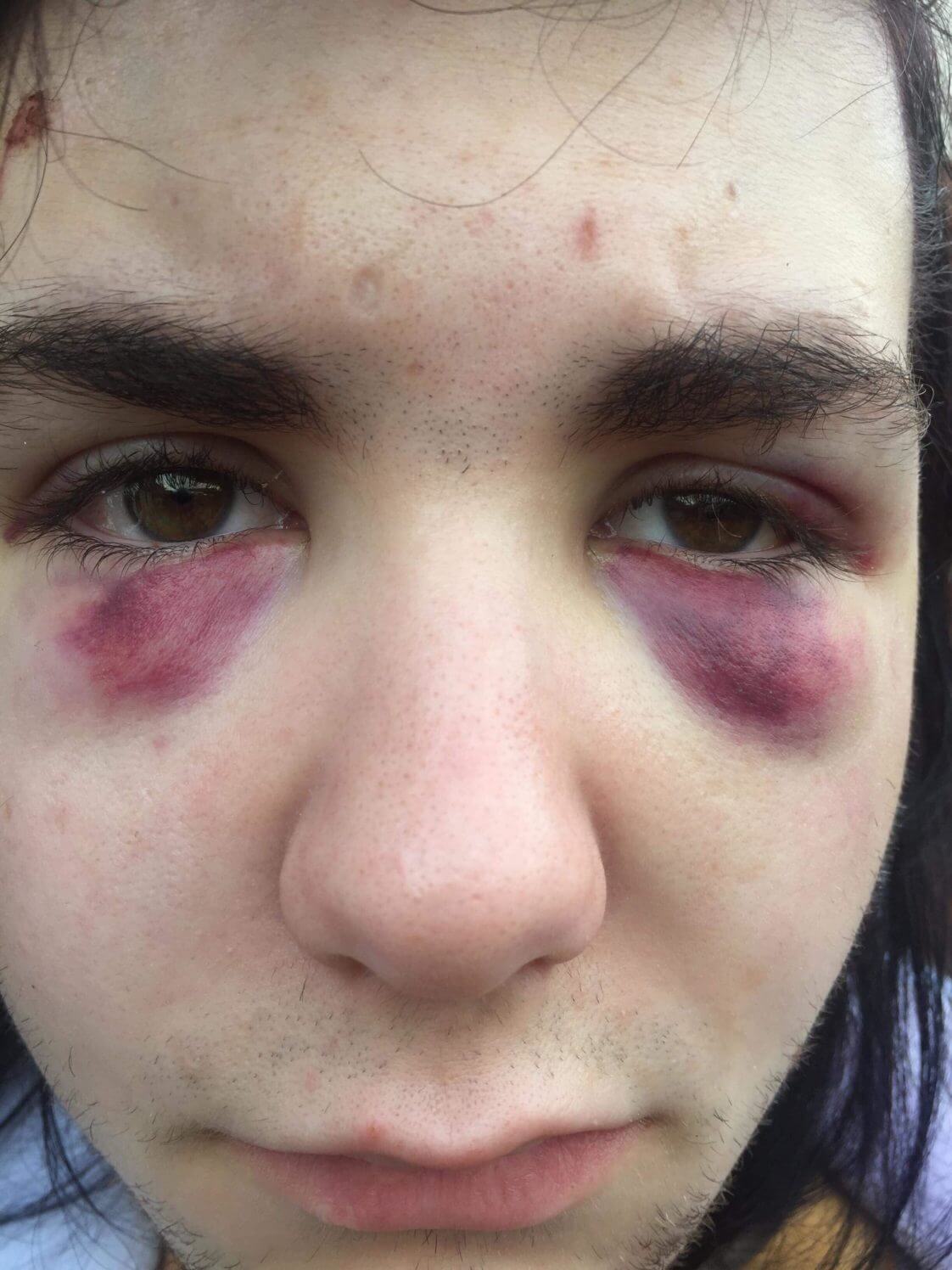 Adolescente picchiato su un bus perché gay: "Non smetterò di essere chi sono" - Kydis Zellinger - Gay.it