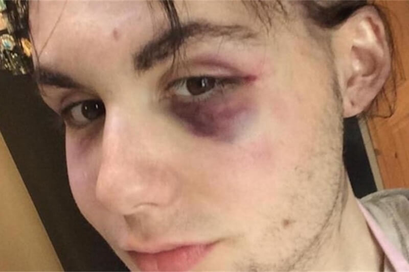 Adolescente picchiato su un bus perché gay: “Non smetterò di essere chi sono”