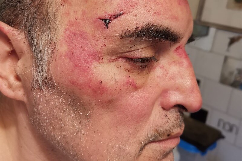 Torino, pestato a sangue al grido “brutto ricchi0ne, ti ammazziamo”