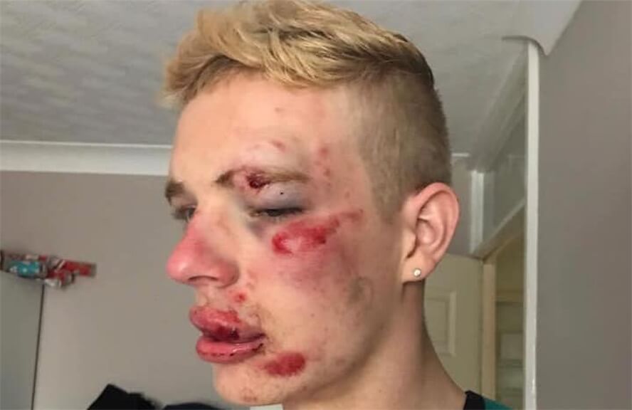 Pestato a sangue perché gay, la denuncia social diventa virale
