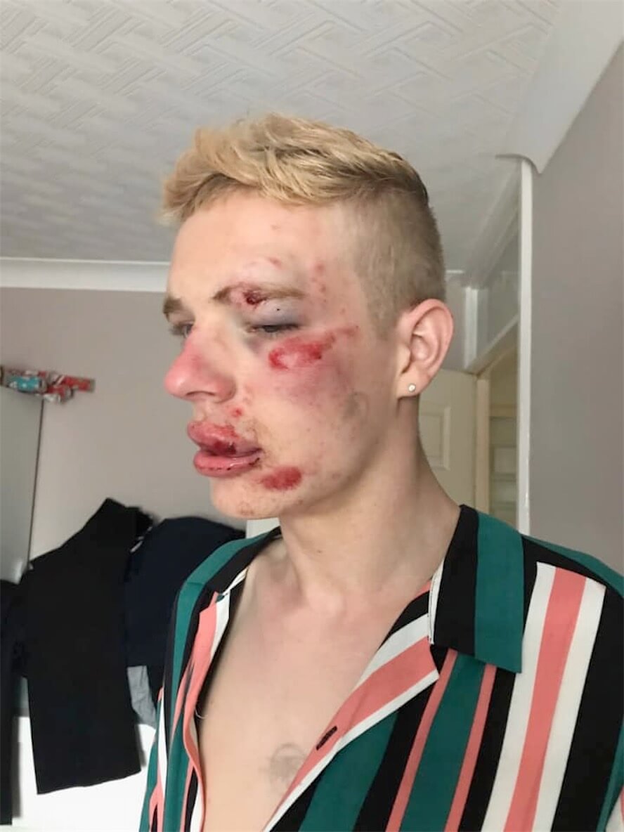 Pestato a sangue perché gay, la denuncia social diventa virale - Ryan Williams - Gay.it