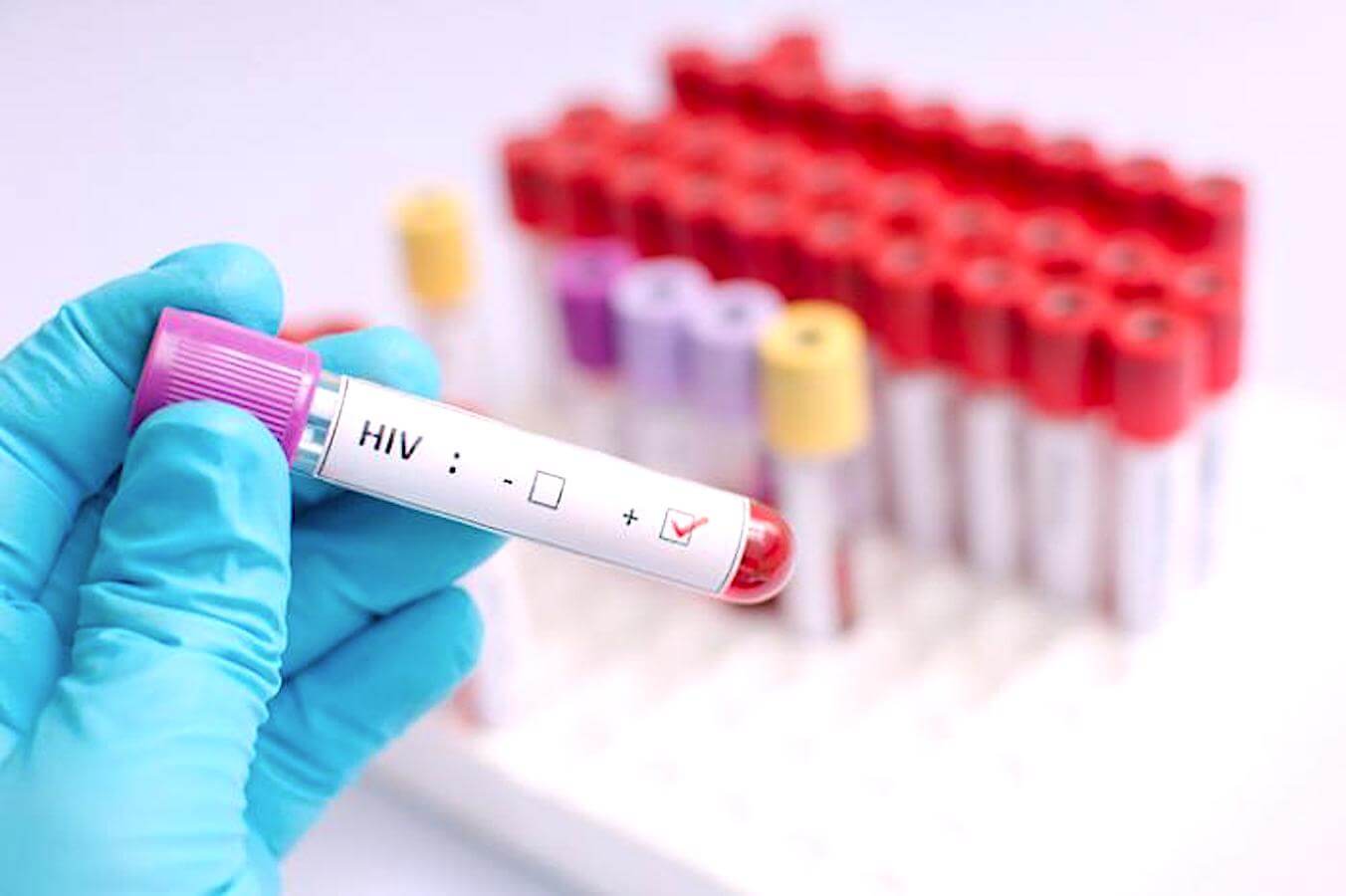hiv gene sieropositive contagi cancro dei gay