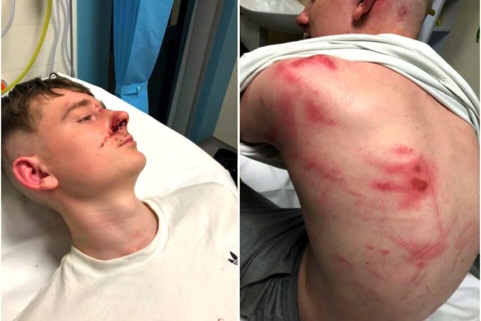 Difende un amico gay da 10 omofobi: 17enne pestato a sangue