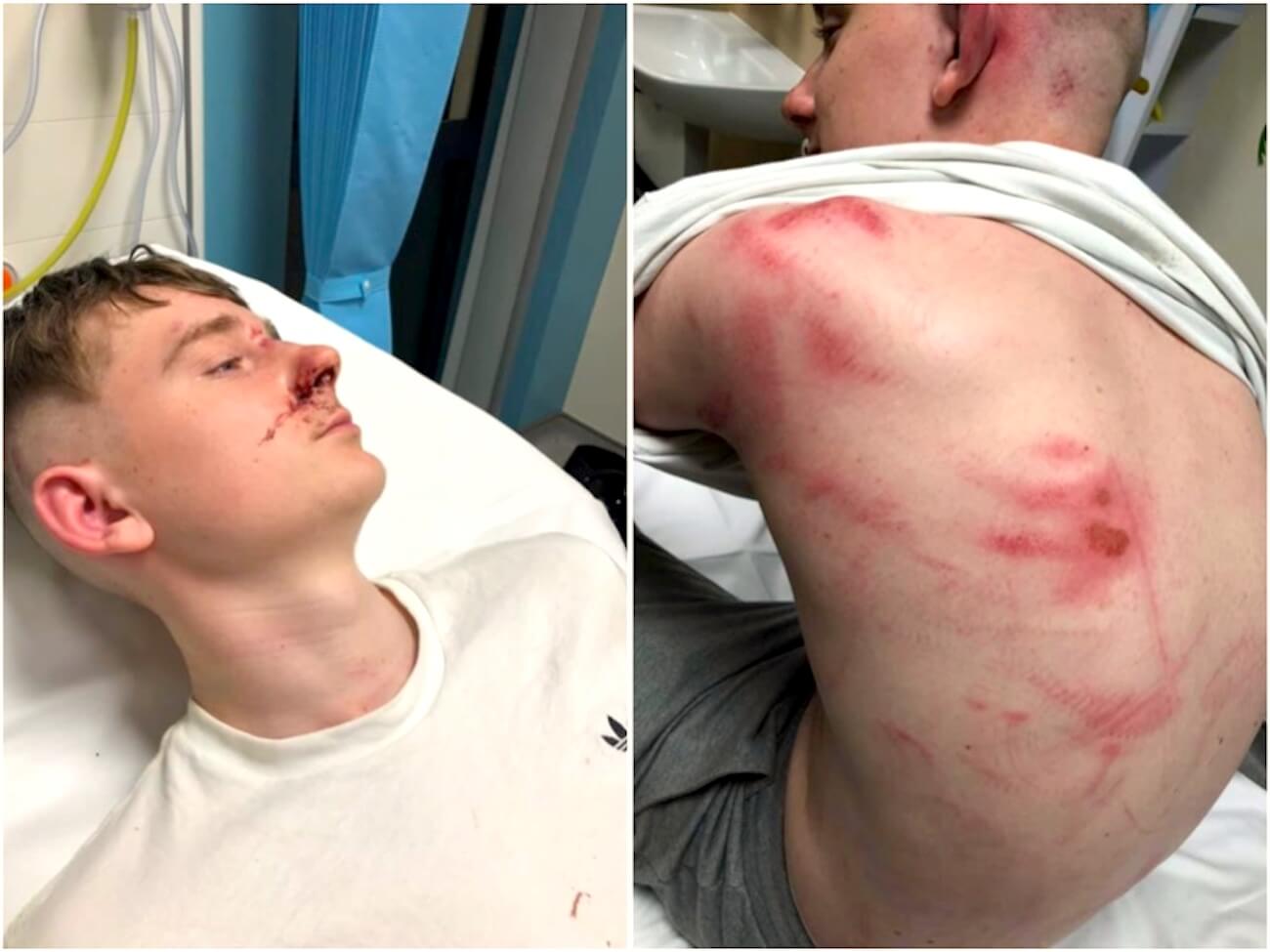 Difende un amico gay da 10 omofobi: 17enne pestato a sangue