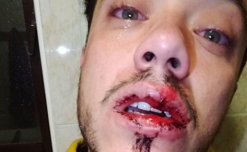 Bacia il compagno, ragazzo pestato a sangue con delle spranghe d’acciaio