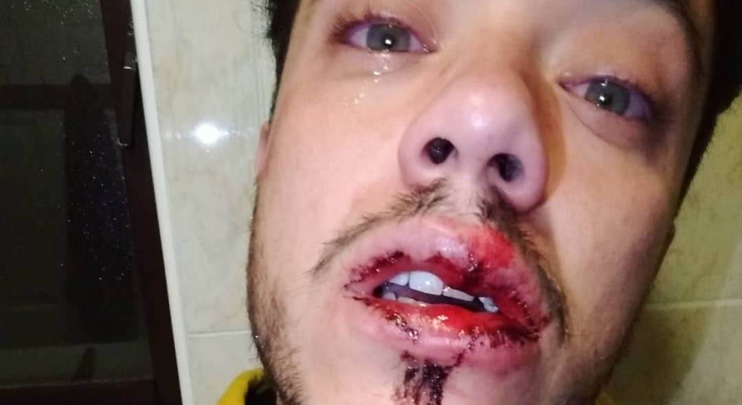 Bacia il compagno, ragazzo pestato a sangue con delle spranghe d’acciaio