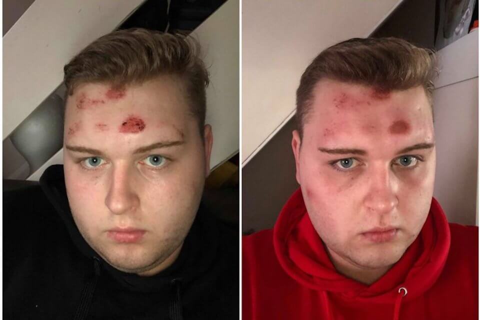 Ragazzo colpito da una pietra alla testa dopo l’insulto “sei un f*ttuto fr*cio”