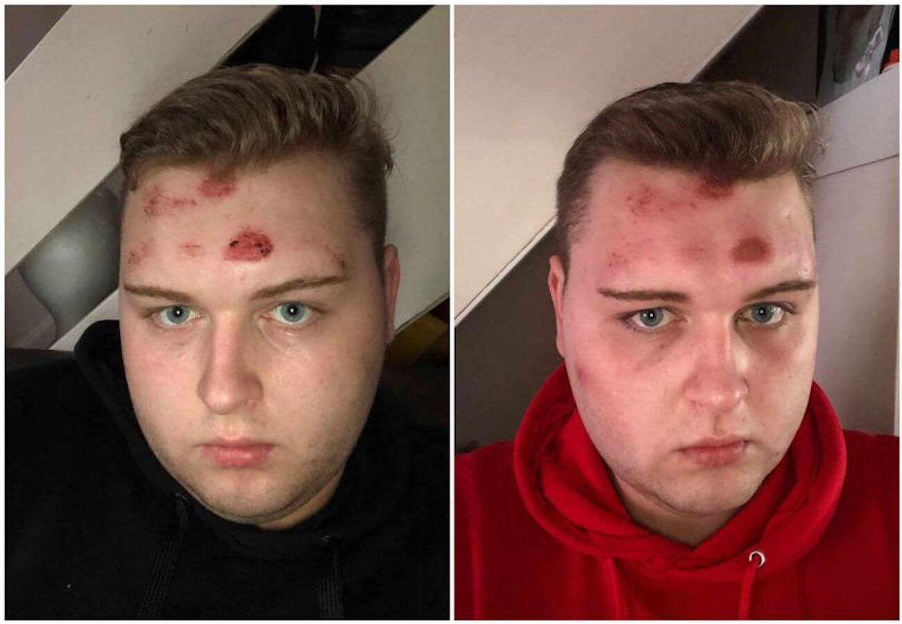 Ragazzo colpito da una pietra alla testa dopo l’insulto “sei un f*ttuto fr*cio”