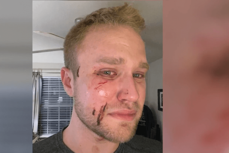 Pestato a sangue mentre gli gridano 'fr*cio', ma i colpevoli sono già fuori di prigione - Pestato a sangue - Gay.it