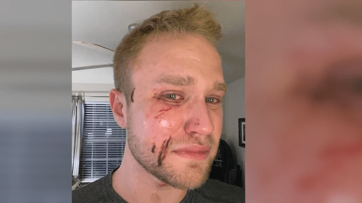 Pestato a sangue mentre gli gridano ‘fr*cio’, ma i colpevoli sono già fuori di prigione