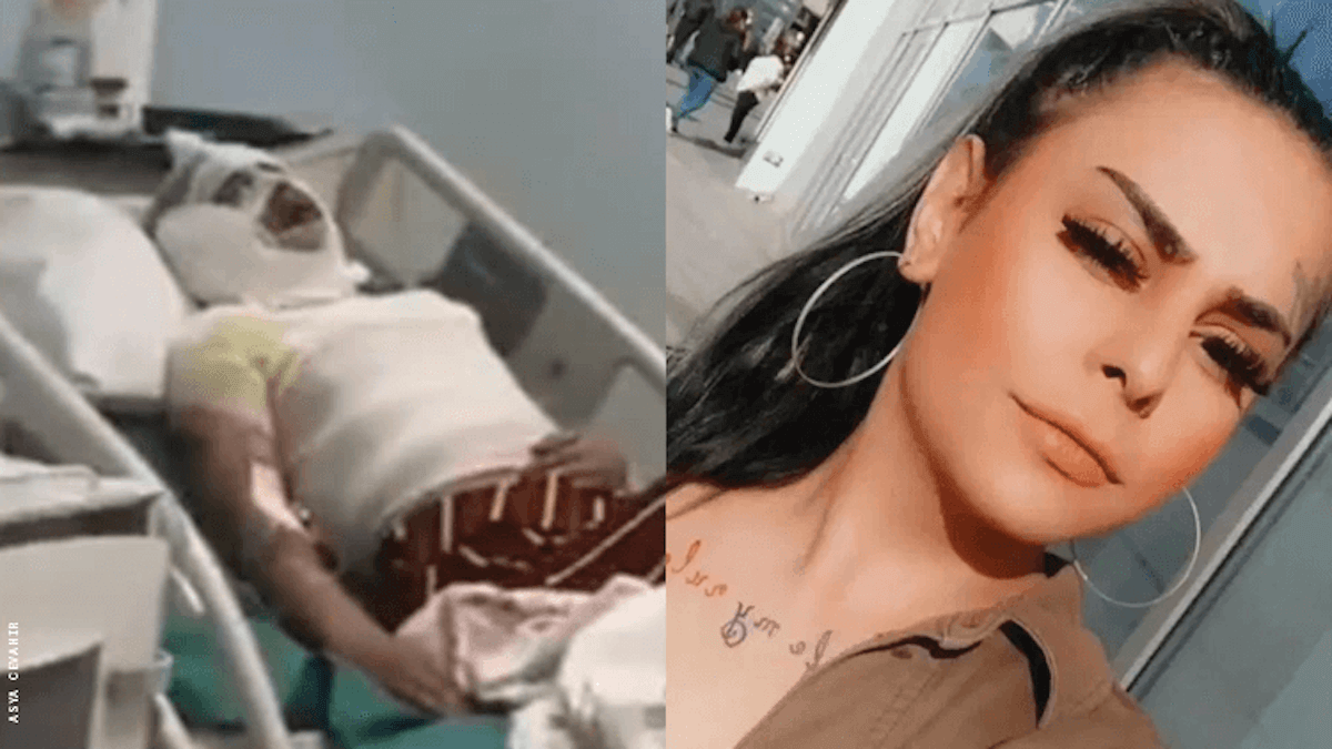Turchia, 18enne trans aggredita con l’acido: ha perso un occhio ed è vittima di transfobia in ospedale