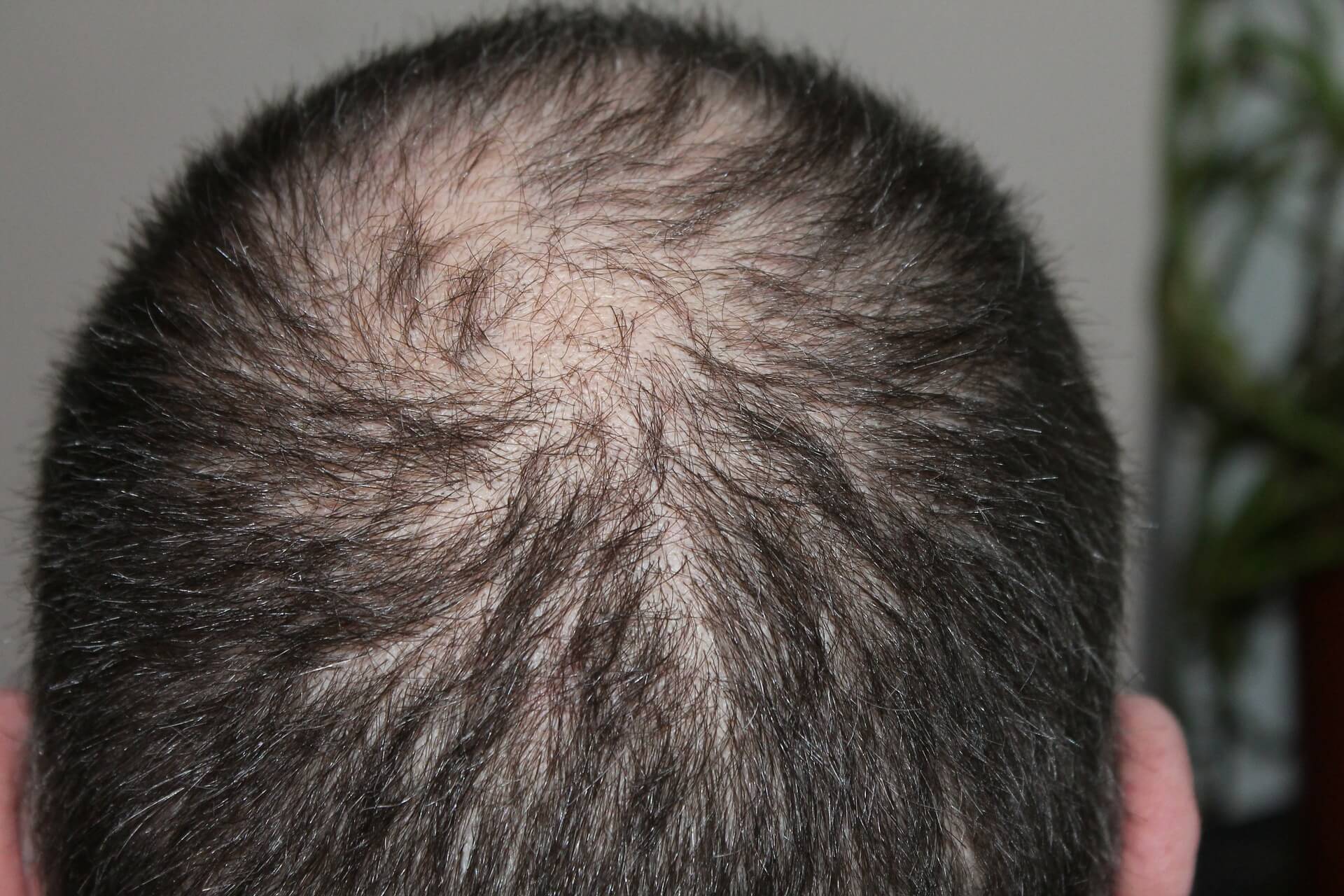 Trapianto di capelli in Turchia: le tecniche e la consulenza migliori