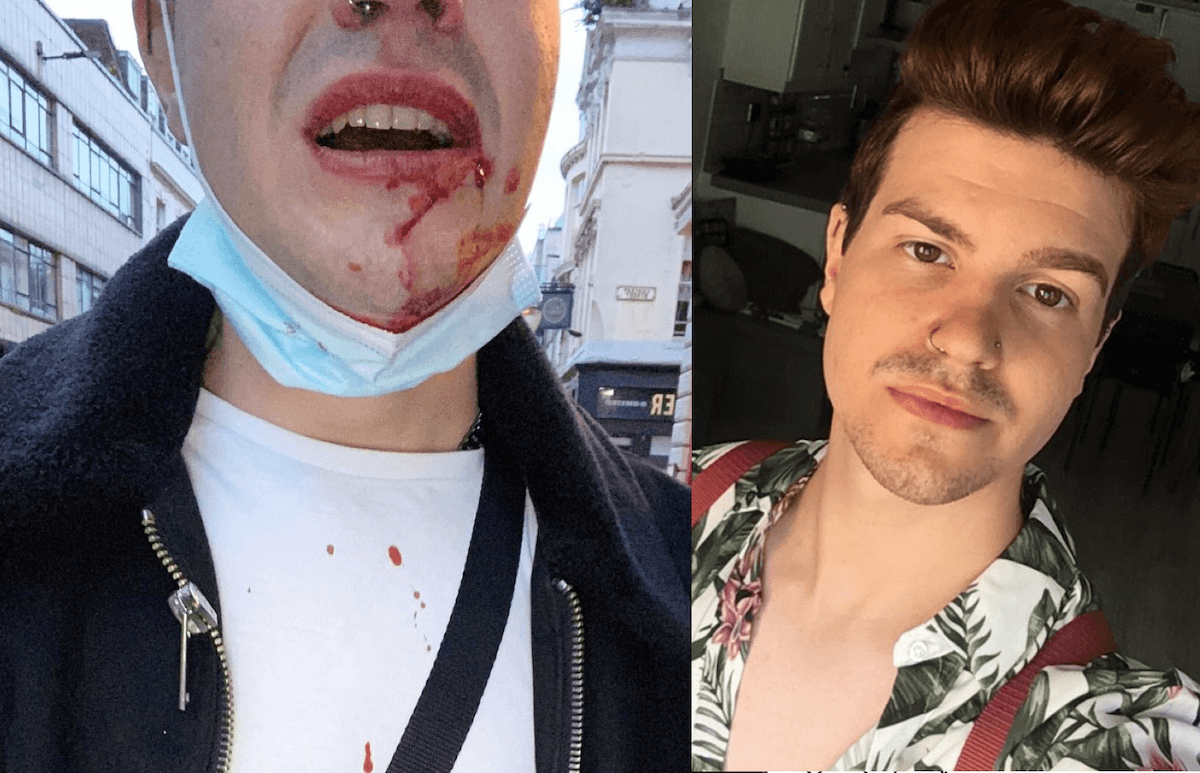 Aggredito con un coltello mentre era con il fidanzato: “Ti uccido, fr*cio”