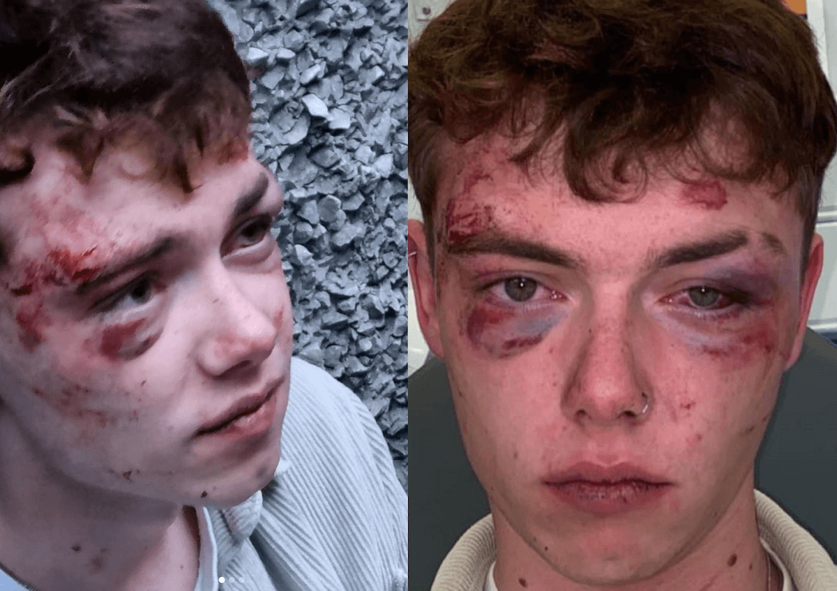 Liverpool, incubo omofobia: in pochi giorni tre ragazzi pestati a sangue