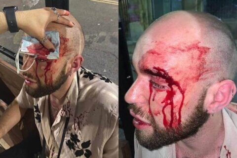 24enne pestato a sange da quattro omofobi: "Non voglio essere gay se questo è il risultato" - Aodhán Benson - Gay.it