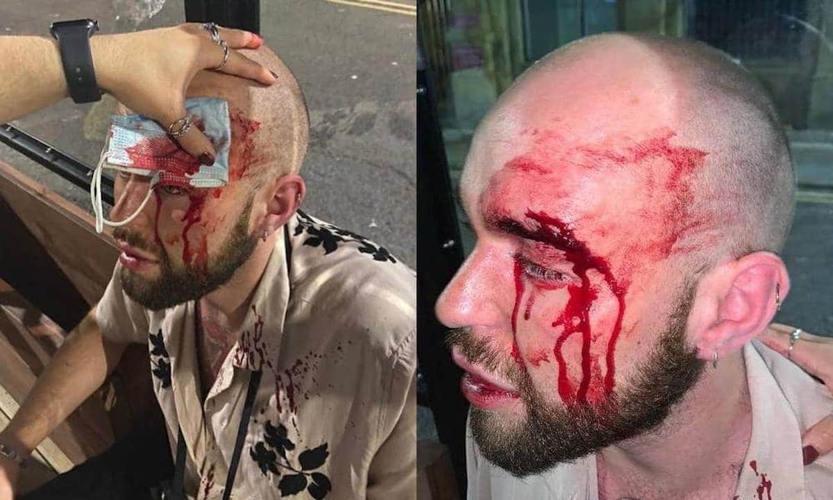 24enne pestato a sange da quattro omofobi: “Non voglio essere gay se questo è il risultato”