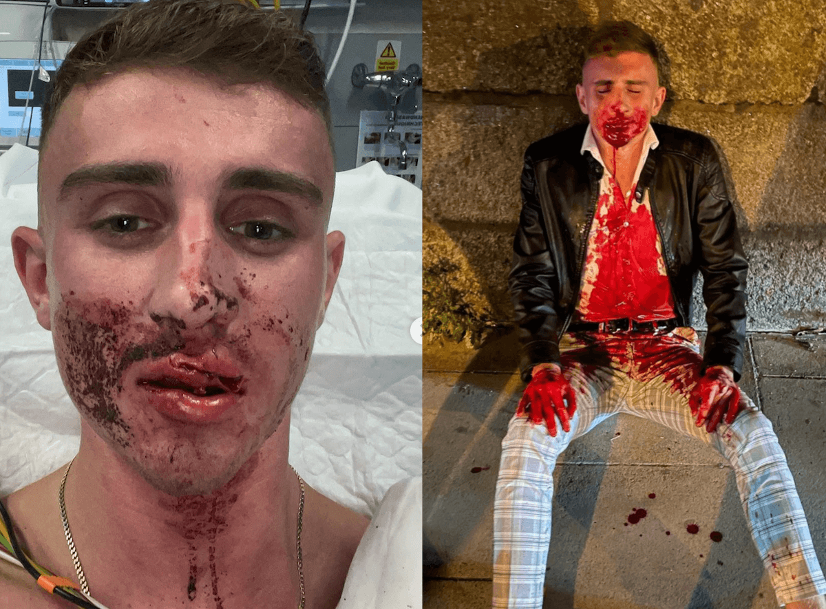 L’olimpionico irlandese Jack Woolley, gay dichiarato, aggredito da 12 persone