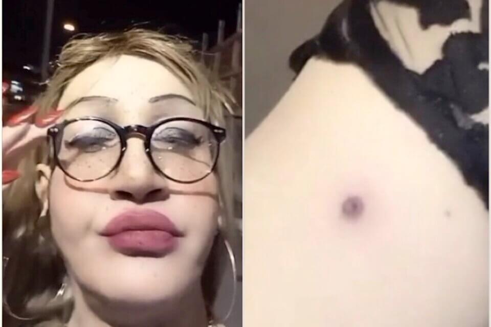 Pompei, banda di ragazzini spara ad una donna trans