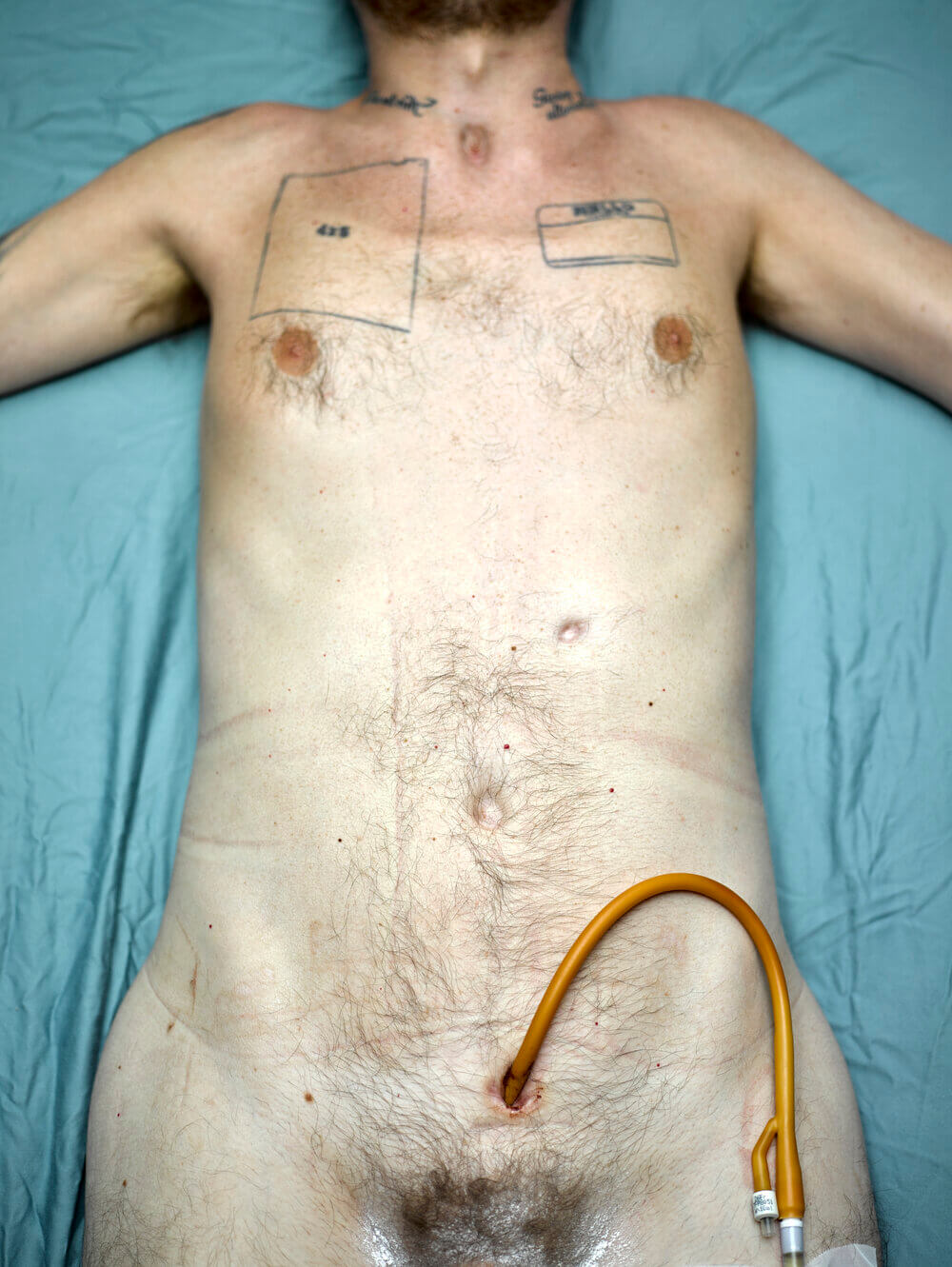 Sesso e disabilità nella fotografia di Robert Andy Coombs: "Dobbiamo autorappresentarci" - Intervista - Suprapubiccatheterin - Gay.it