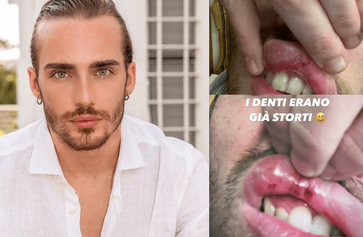 Simone Baroni, aggressione omofoba per l’ex ballerino di Amici: “Erano in 5/6, preso a pugni senza motivo”