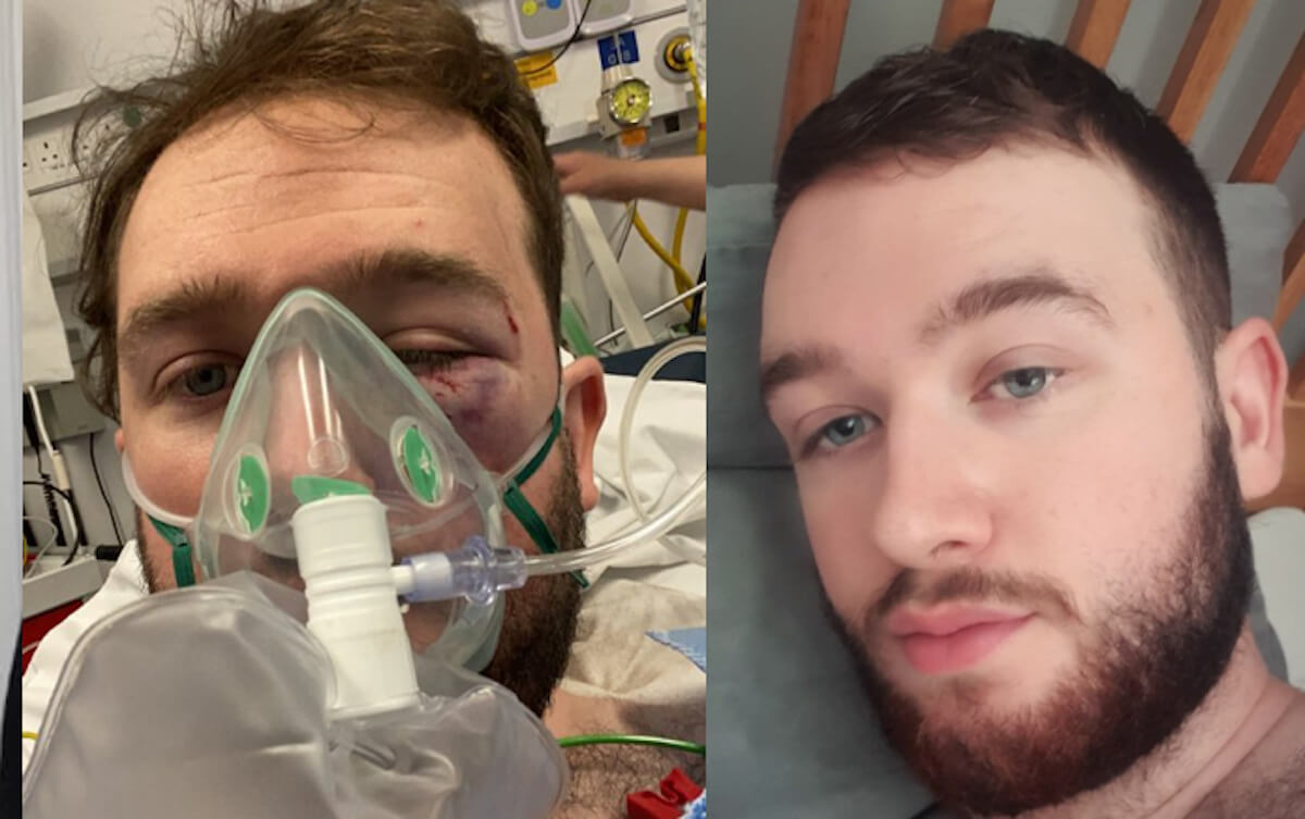 Evan Somers, giocatore gay di rugby pestato a sangue da un gruppo di omofobi