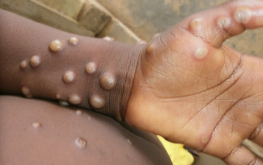 Il virus di Mpox (monkeypox) si diffonde in Europa, focolaio tra la comunità gay?