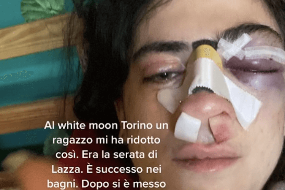 Torino, difende il fidanzato da un commento omofobo, 20enne presa a pugni: "Aiutatemi a trovare il colpevole" - Difende il fidanzato da un commento omofobo 20enne presa a pugni - Gay.it