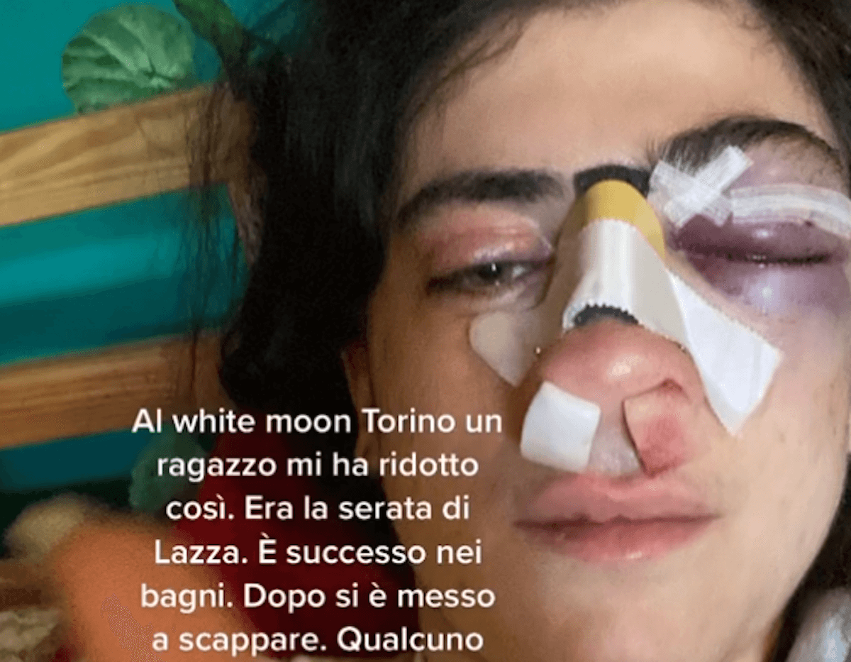 Torino, difende il fidanzato da un commento omofobo, 20enne presa a pugni: “Aiutatemi a trovare il colpevole”