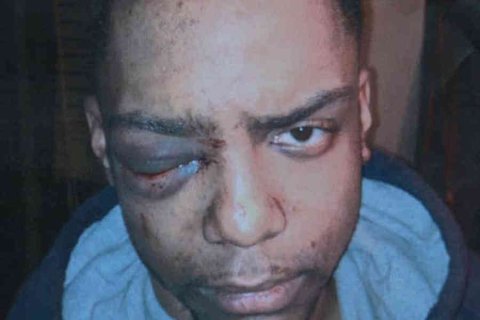 Ragazzo gay perse un occhio dopo brutale aggressione. Risarcimento da 4,5 milioni di dollari - Taj Patterson - Gay.it