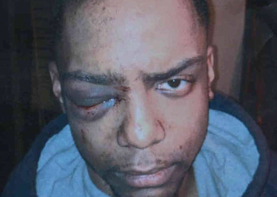 Ragazzo gay perse un occhio dopo brutale aggressione. Risarcimento da 4,5 milioni di dollari