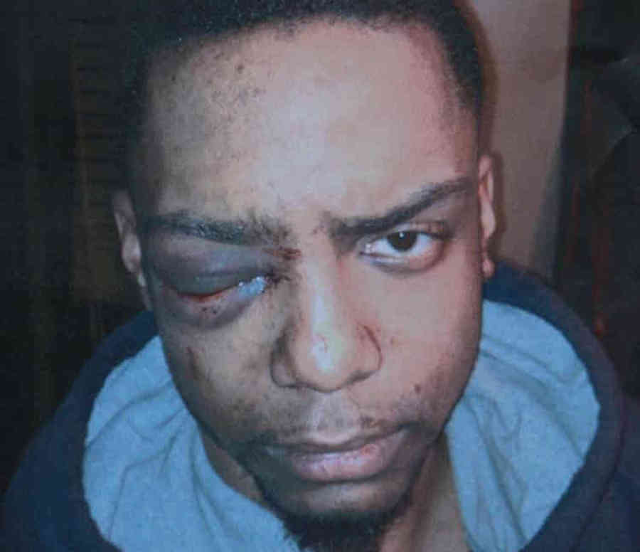 Ragazzo gay perse un occhio dopo brutale aggressione. Risarcimento da 4,5 milioni di dollari