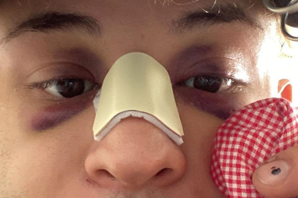 Riccione, aggressione omofoba ai danni di un universitario: prima gli insulti, poi le botte