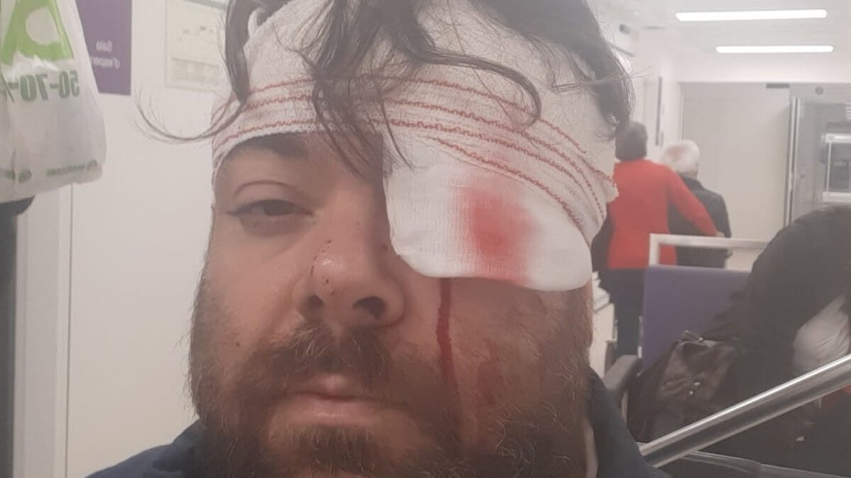 Pasquale Ciano, aggressione omofoba a Sitges: “Ho rischiato di perdere l’occhio”