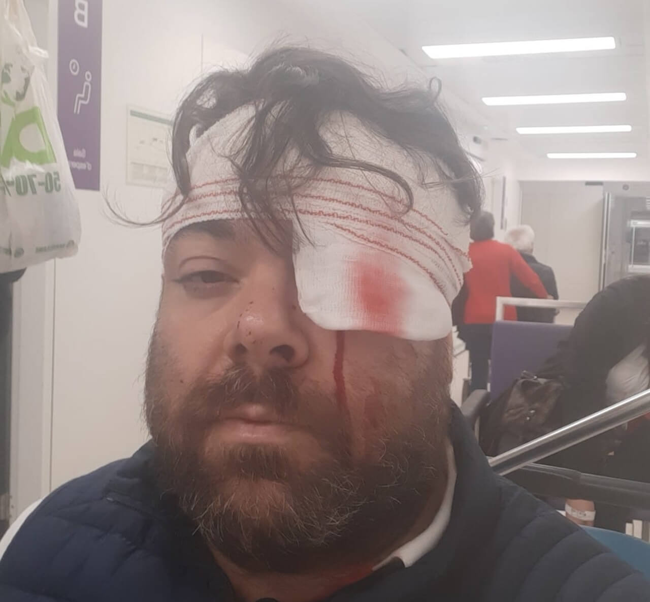 Pasquale Ciano, aggressione omofoba a Sitges: “Ho rischiato di perdere l’occhio”
