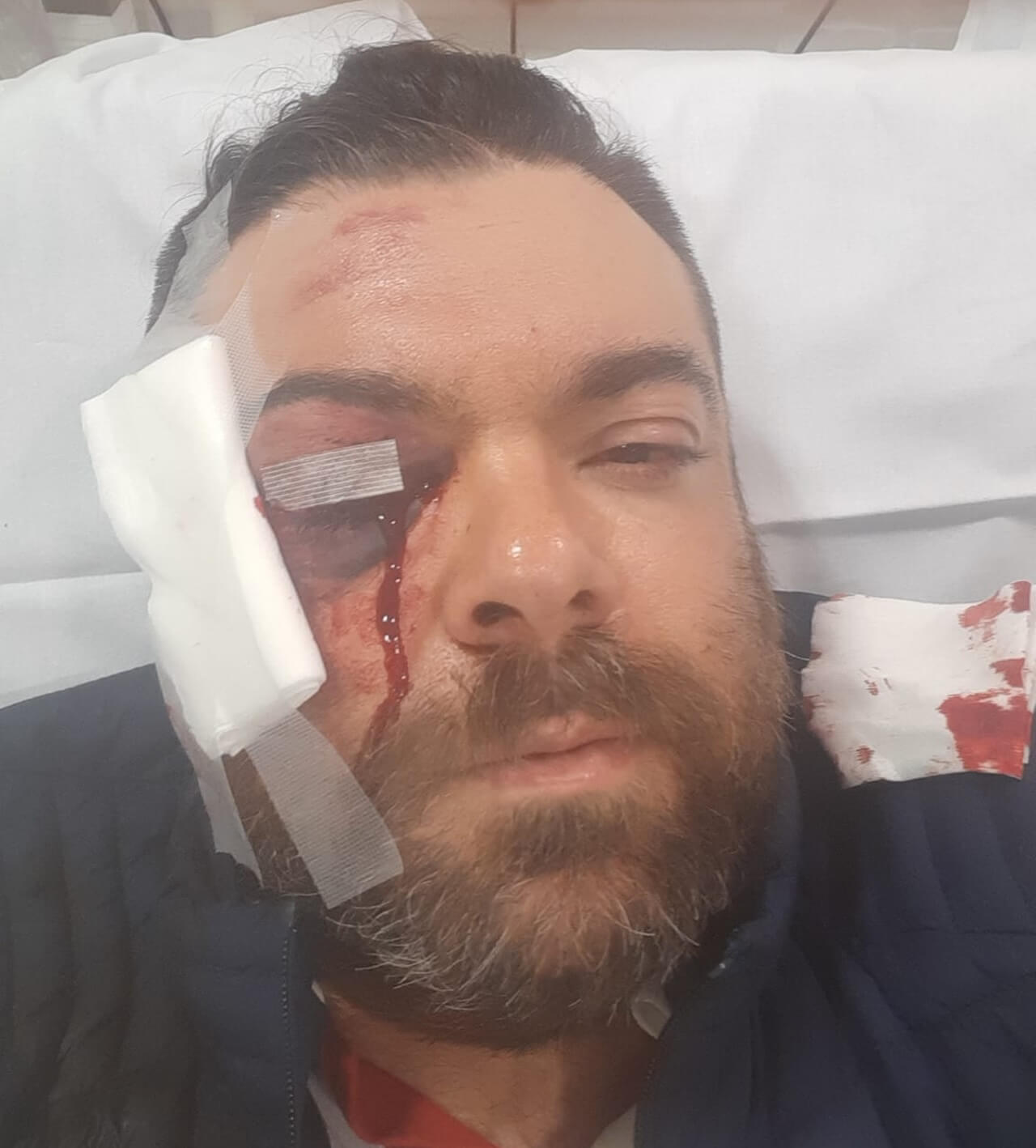 Pasquale Ciano, aggressione omofoba a Sitges: "Ho rischiato di perdere l'occhio" - Pasquale Ciano - Gay.it