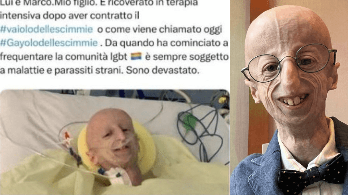Sammy Basso, una sua foto utilizzata per diffondere fake news omofobe sul MPox
