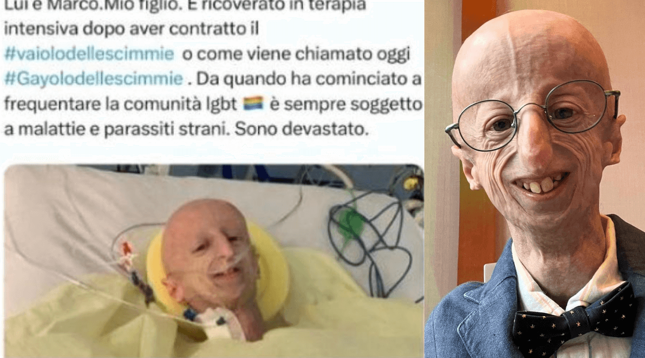 Sammy Basso, una sua foto utilizzata per diffondere fake news omofobe sul MPox