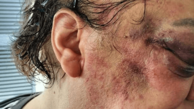 San Giovanni Rotondo, venne picchiato perché gay. Riconosciuta l’aggravante della matrice omofoba, la sentenza - aggressione san giovanni rotondo 2 - Gay.it