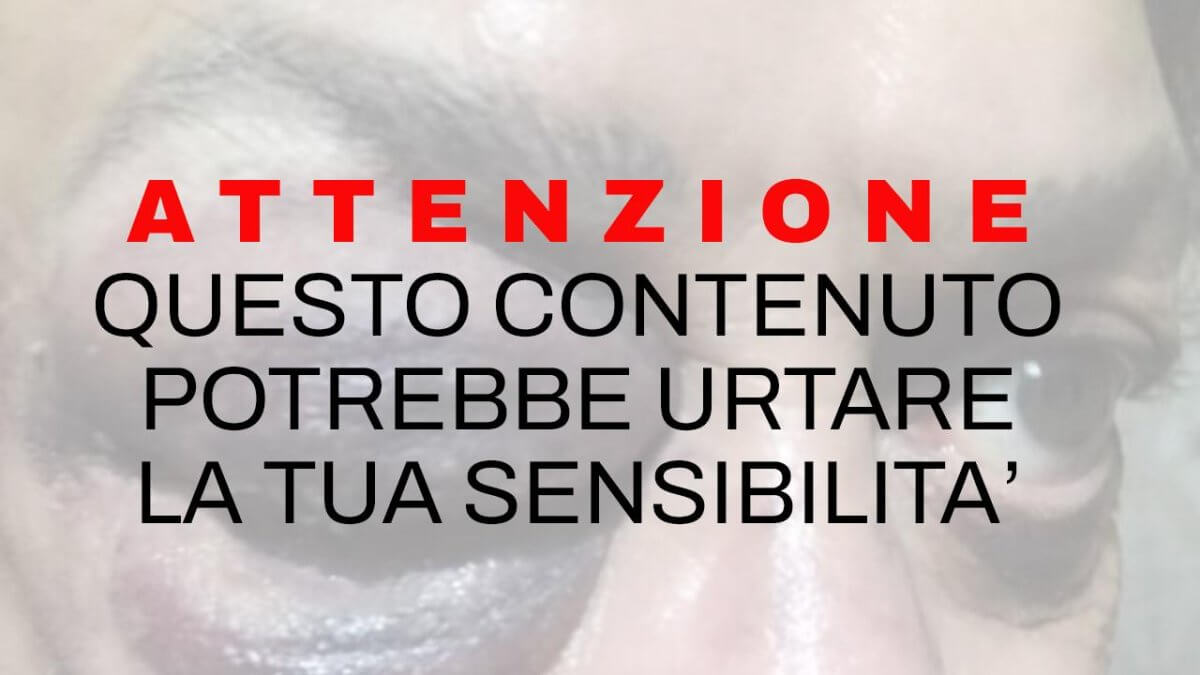 San Giovanni Rotondo, aggredito a calci in faccia perché gay: “Ecco cosa succede con i vostri post omofobi e l’educazione che date ai vostri figli…”