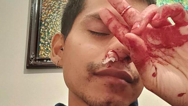 Torino, pugni in faccia ad un ragazzo che passeggiava con il compagno - Torino pugni in faccia ad un ragazzo che passeggiava con il compagno - Gay.it