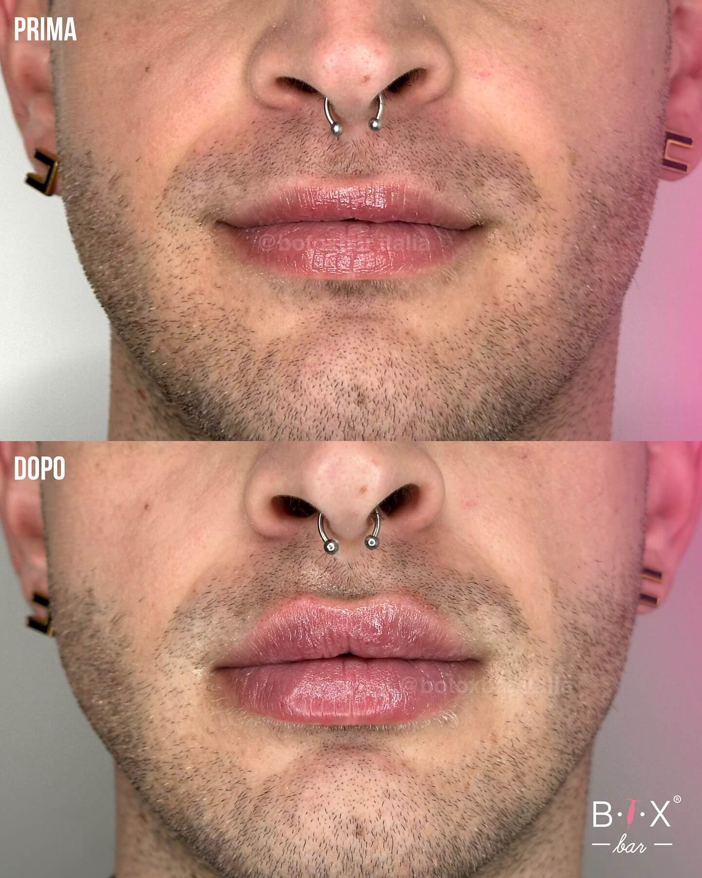 Medicina Estetica: trattamenti più scelti dagli uomini al BTX Bar - lip filler - Gay.it