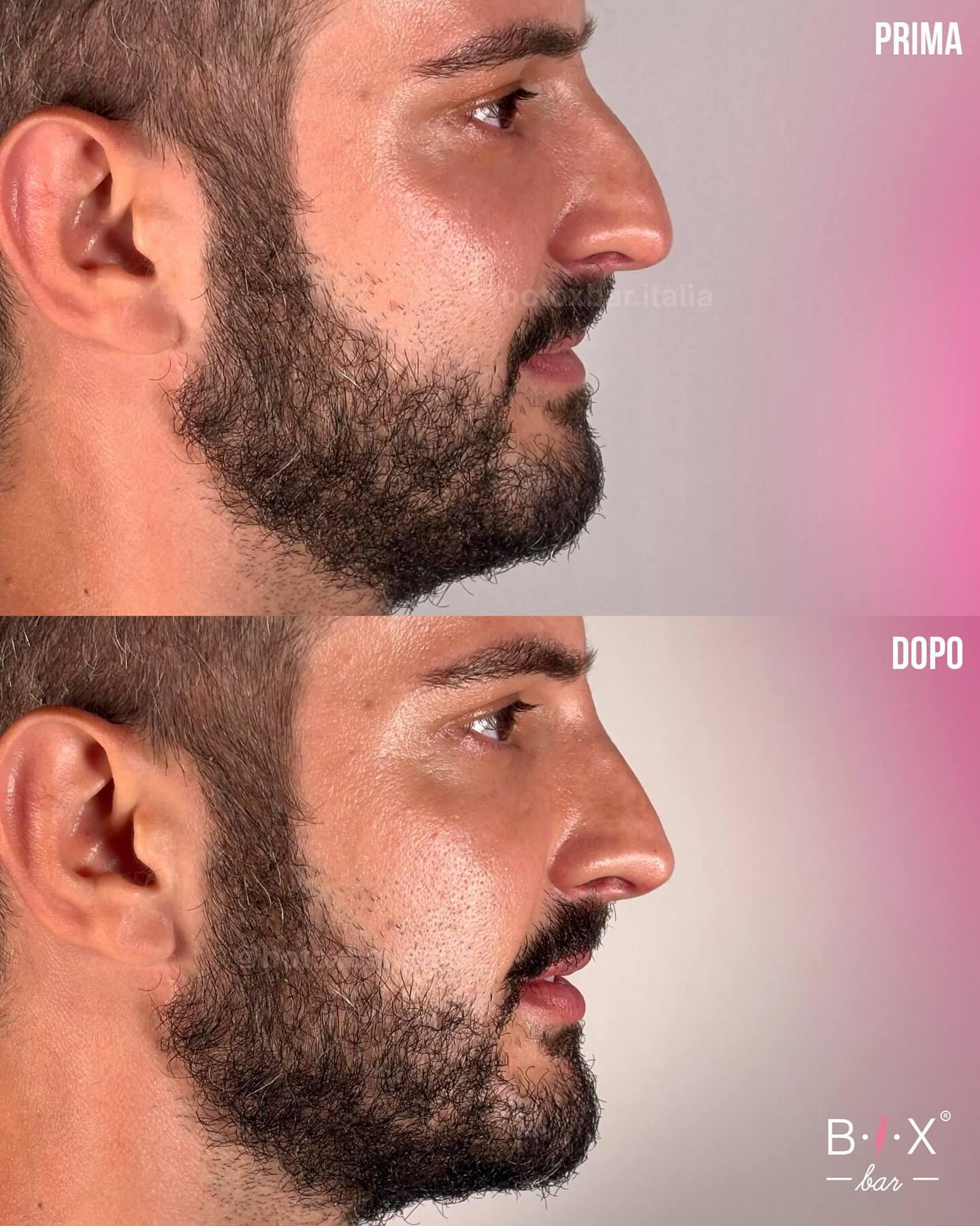 Medicina Estetica: trattamenti più scelti dagli uomini al BTX Bar - rinofiller - Gay.it