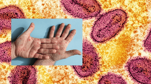 Mpox, in Lombardia focolaio con 15 casi del ceppo più aggressivo, LILA: "Chi è a rischio si vaccini, non è un virus gay" - MPOX Lombardia ceppo Ib 15 casi - Gay.it