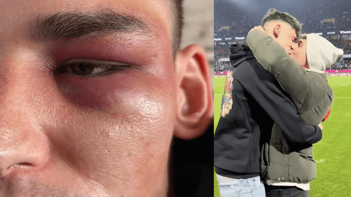 A sinistra il volto di Pascal Kaiser tumefatto dopo l'aggressione omofobica (foto SimilQueer). A destra la proposta di matrimonio al suo compagno Moritz di una settimana fa.